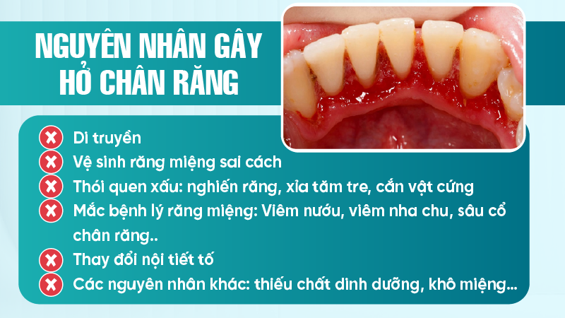 Nguyên nhân gây hở chân răng