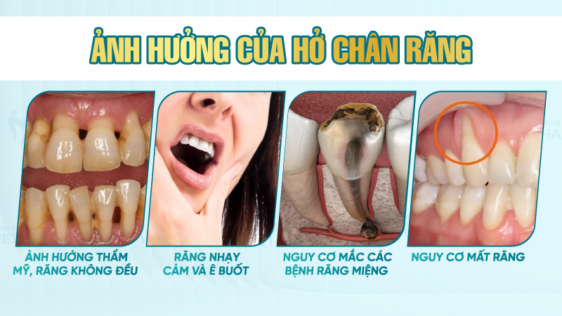 Ảnh hưởng của hở chân răng