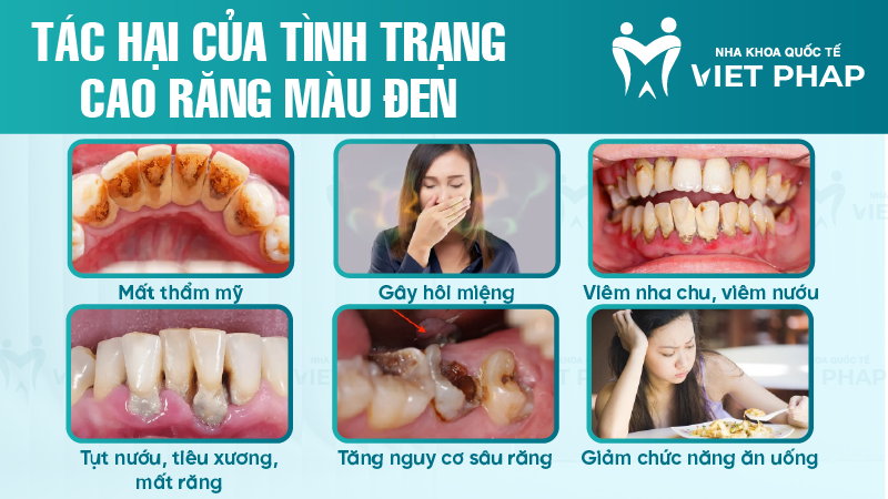Tác hại của tình trạng cao răng màu đen