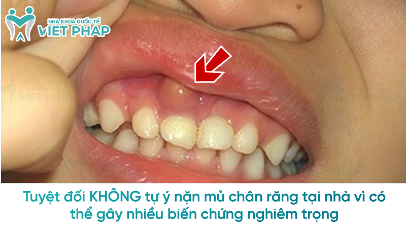 Tuyệt đối KHÔNG tự ý nặn mủ chân răng tại nhà vì có thể gây nhiều biến chứng nghiêm trọng