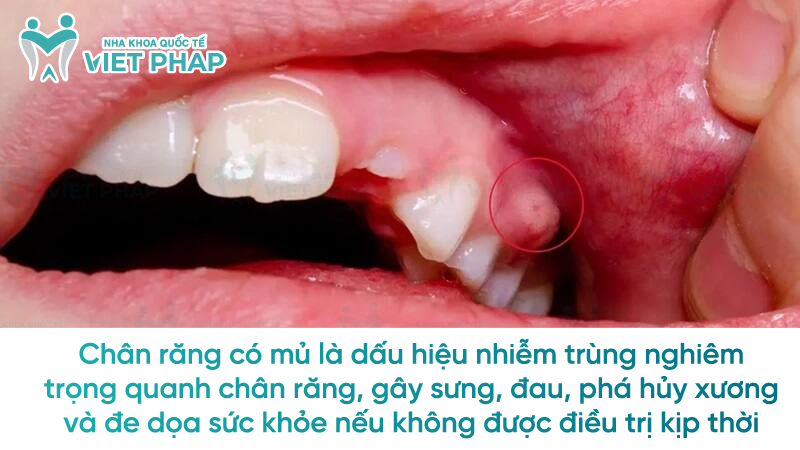 Chân răng có mủ là dấu hiệu nhiễm trùng nghiêm trọng quanh chân răng, gây sưng, đau, phá hủy xương và đe dọa sức khỏe nếu không được điều trị kịp thời 