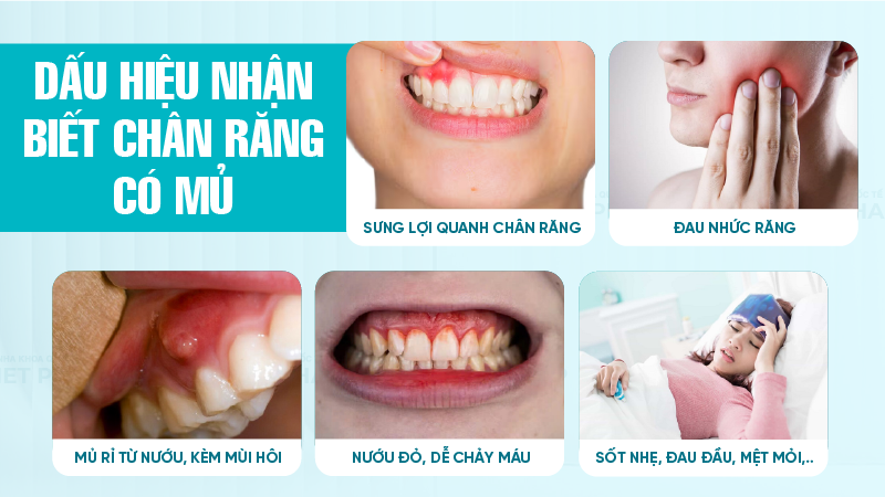 Dấu hiệu nhận biết chân răng có mủ