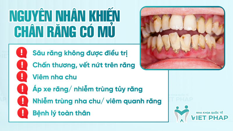 Nguyên nhân khiến chân răng có mủ
