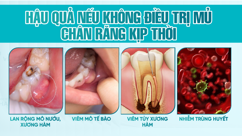 Hậu quả nếu không điều trị mủ chân răng kịp thời