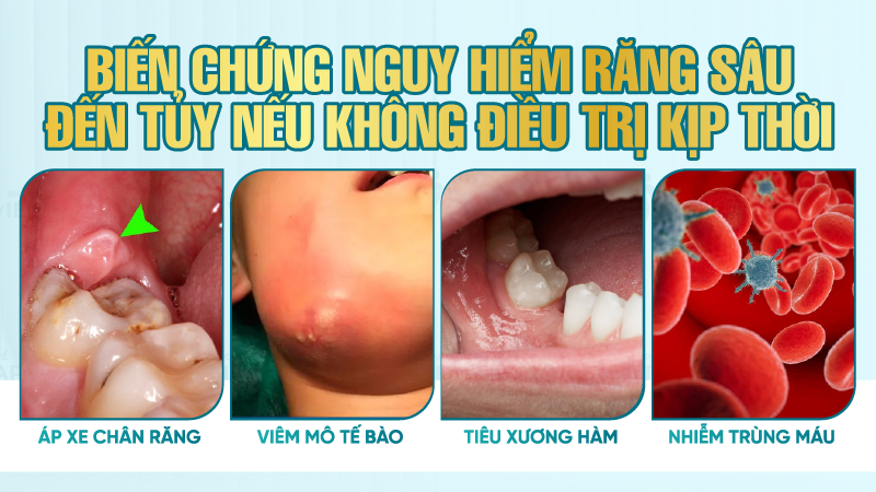 Biến chứng nguy hiểm răng sâu đến tủy nếu không điều trị kịp thời