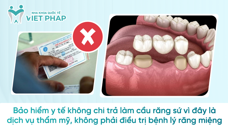 Bảo hiểm y tế không chi trả làm cầu răng sứ vì đây là dịch vụ thẩm mỹ, không phải điều trị bệnh lý răng miệng