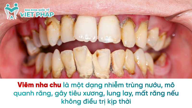 Viêm nha chu là một dạng nhiễm trùng nướu, mô quanh răng, gây tiêu xương, lung lay, mất răng nếu không điều trị kịp thời 