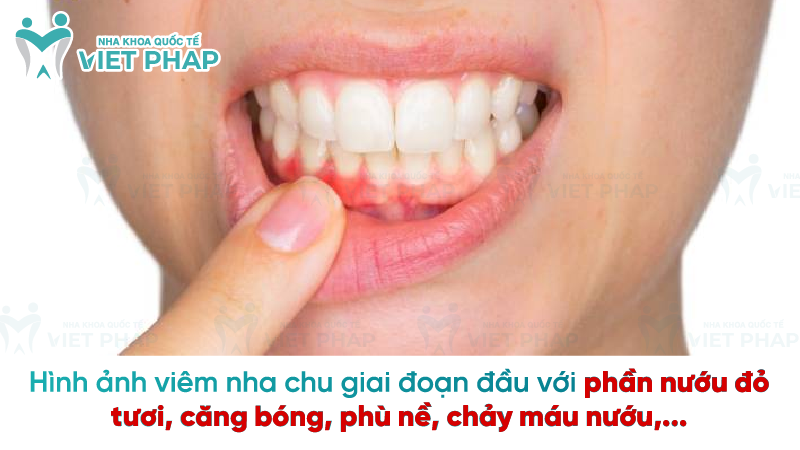 Hình ảnh viêm nha chu giai đoạn đầu với phần nướu đỏ tươi, căng bóng, phù nề, chảy máu nướu,...