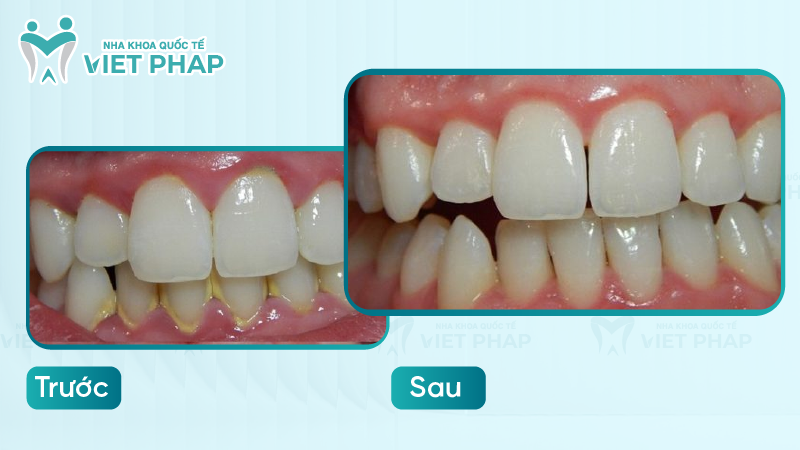 Hình ảnh khách hàng điều trị viêm nha chu giai đoạn đầu viêm nướu