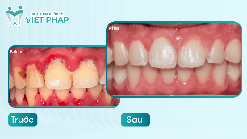 Khách hàng sau khi điều trị viêm nha chu tình trạng sưng biến mất, lợi màu hồng nhạt