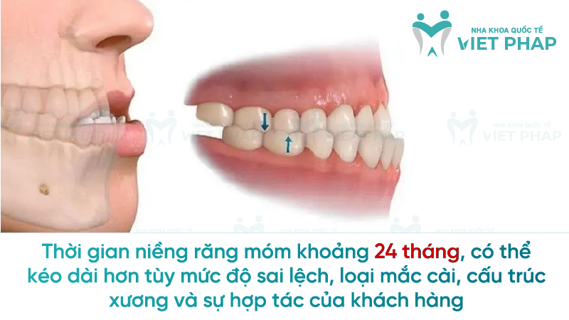 Nieng rang mom bao nhieu tien 1 Thời gian niềng răng móm khoảng 24 tháng, có thể kéo dài hơn tùy mức độ sai lệch, loại mắc cài, cấu trúc xương và sự hợp tác của khách hàng
