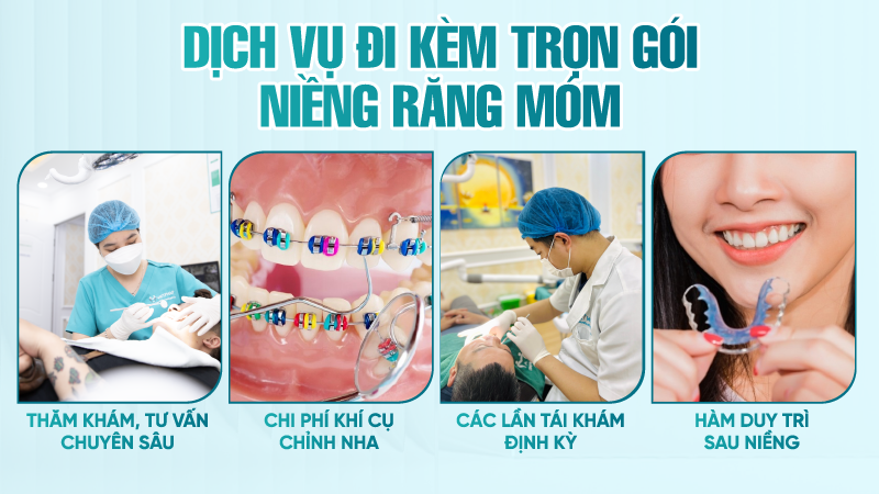 Nieng rang mom bao nhieu tien 4 Dịch vụ đi kèm trọn gói niềng răng móm