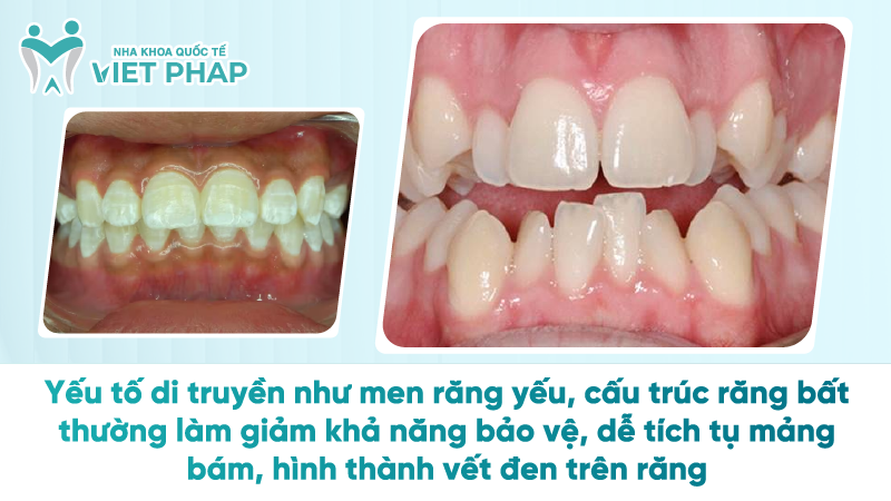 Yếu tố di truyền như men răng yếu, cấu trúc răng bất thường làm giảm khả năng bảo vệ, dễ tích tụ mảng bám, hình thành vết đen trên răng