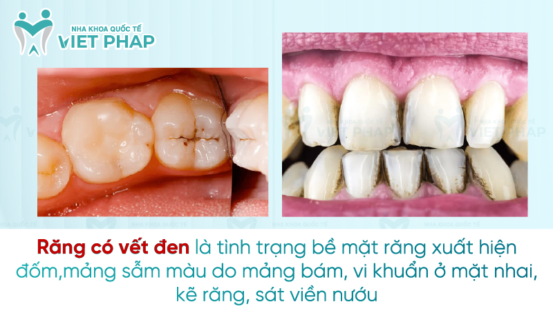 Rang co cet den 1 Răng có vết đen là tình trạng bề mặt răng xuất hiện đốm,mảng sẫm màu do mảng bám, vi khuẩn ở mặt nhai, kẽ răng, sát viền nướu
