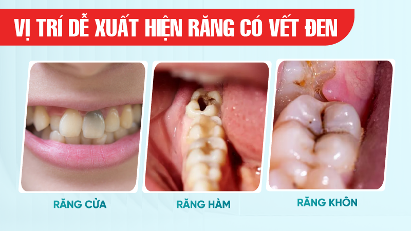 Rang co cet den 3 Vị trí dễ xuất hiện răng có vết đen