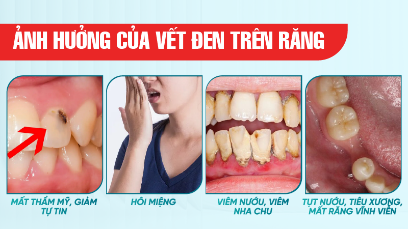 Rang co cet den 5 Ảnh hưởng của vết đen trên răng