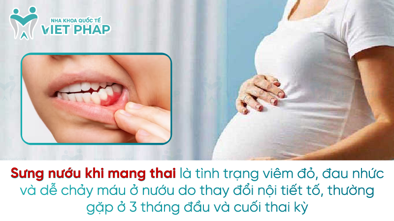 Sung nuou khi mang thai 1 Sưng nướu khi mang thai là tình trạng viêm đỏ, đau nhức và dễ chảy máu ở nướu do thay đổi nội tiết tố, thường gặp ở 3 tháng đầu và cuối thai kỳ