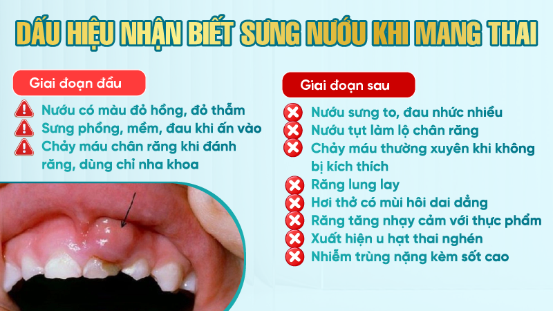 Sung nuou khi mang thai 3 Dấu hiệu nhận biết sưng nướu khi mang thai
