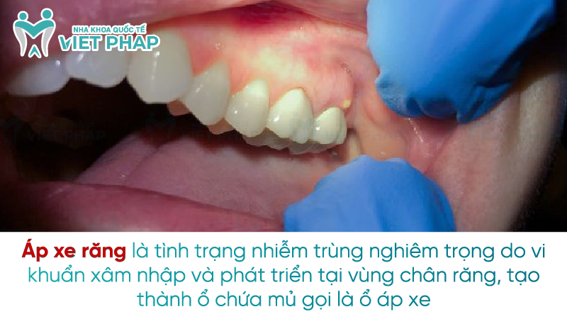 ap xe rang la gi 1 Áp xe răng là tình trạng nhiễm trùng nghiêm trọng do vi khuẩn xâm nhập và phát triển tại vùng chân răng, tạo thành ổ chứa mủ gọi là ổ áp xe