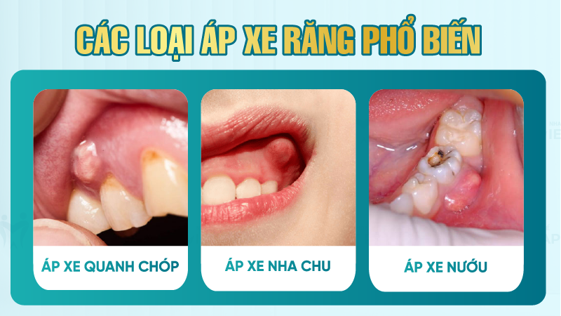 ap xe rang la gi 2 Các loại áp xe răng phổ biến