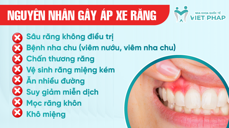 ap xe rang la gi 3 Nguyên nhân gây áp xe răng