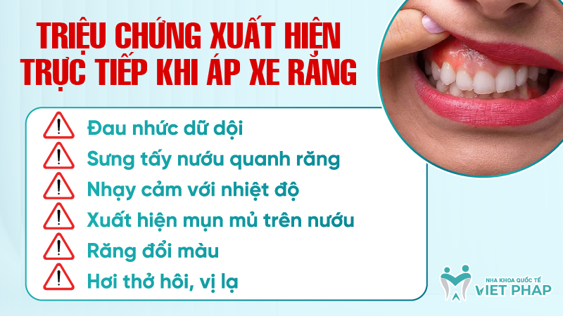ap xe rang la gi 4 Triệu chứng xuất hiện trực tiếp khi áp xe răng