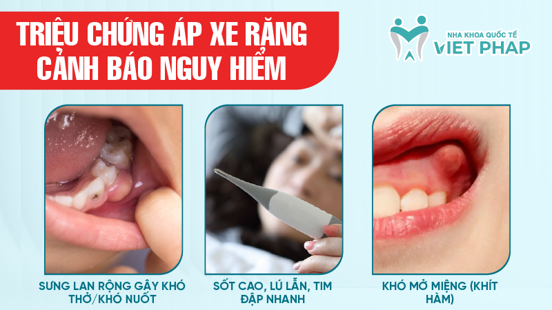 ap xe rang la gi 5 Triệu chứng áp xe răng cảnh báo nguy hiểm