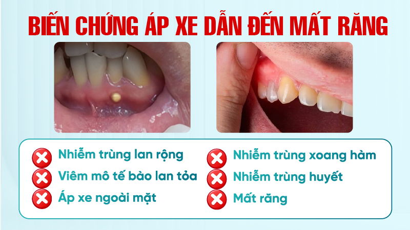 ap xe rang la gi 6 Biến chứng áp xe dẫn đến mất răng