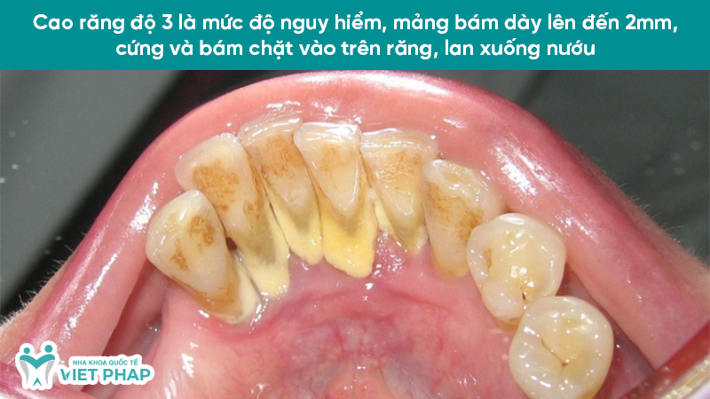 Cao răng độ 3 là mức độ nguy hiểm, mảng bám dày lên đến 2mm, cứng và bám chặt vào trên răng, lan xuống nướu