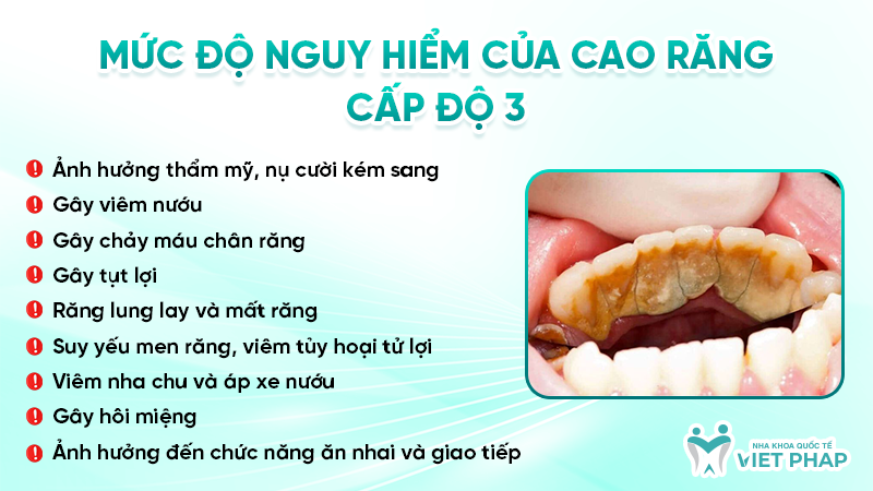 Mức độ nguy hiểm của cao răng cấp độ 3