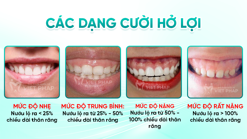 Các dạng cười hở lợi