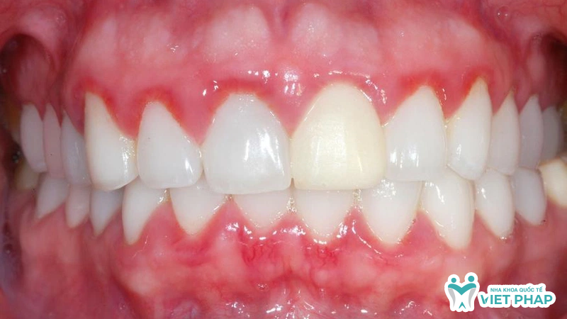 Hình ảnh lợi bị đỏ và sưng tấy do viêm