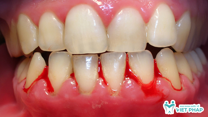 Hình ảnh chảy máu chân răng ở vùng nướu gần chân răng