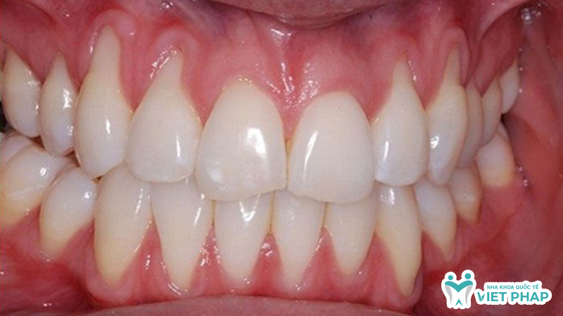 Hình ảnh lợi bị tụt khỏi chân răng