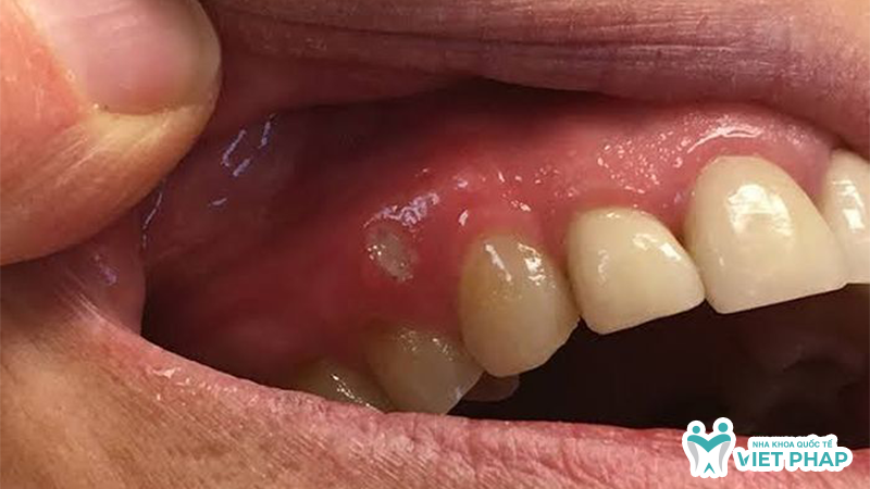 Hình ảnh vùng lợi bị đỏ, xuất hiện vết loét màu trắng