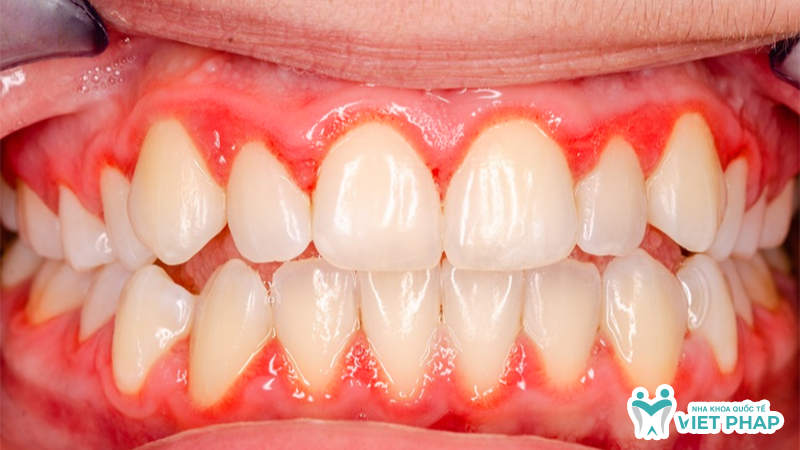 Hình ảnh nướu bị viêm có màu đỏ tươi hoặc đỏ tím