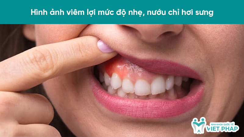 Hình ảnh viêm lợi mức độ nhẹ, nướu chỉ hơi sưng