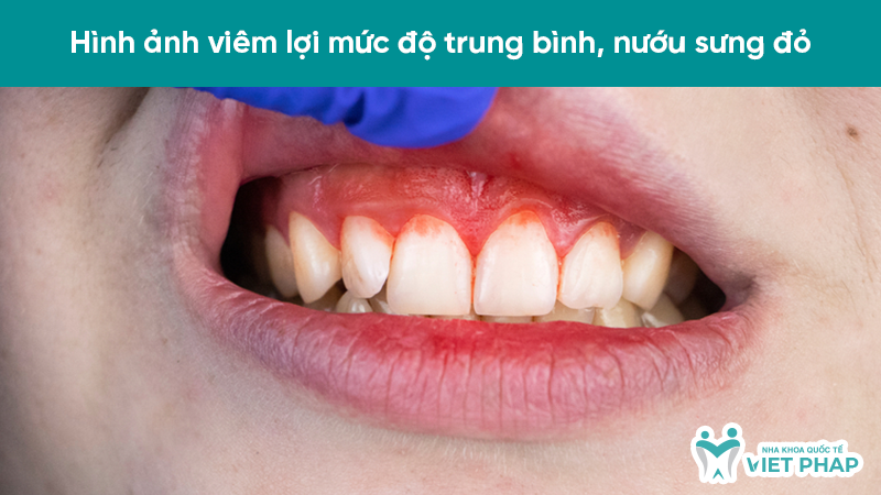 Hình ảnh viêm lợi mức độ trung bình, nướu sưng đỏ