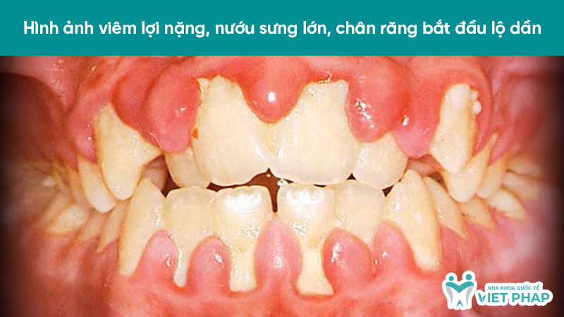 Hình ảnh viêm lợi nặng, nướu sưng lớn, chân răng bắt đầu lộ dần