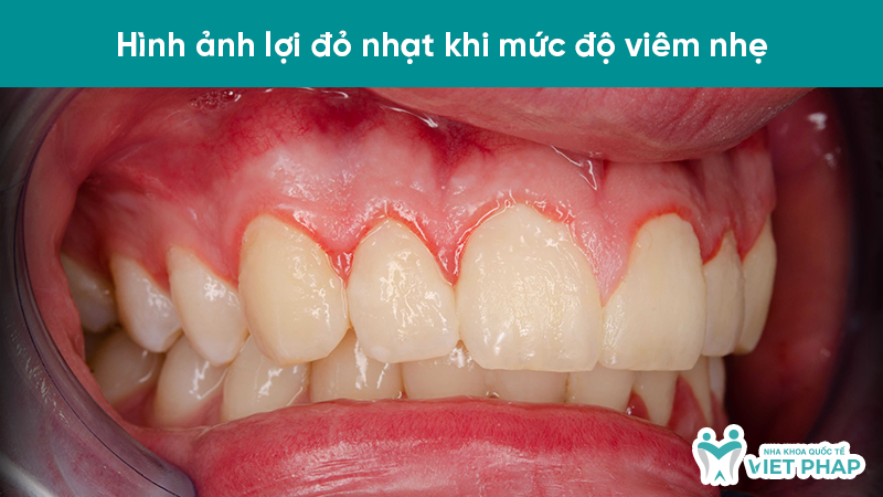 Hình ảnh lợi đỏ nhạt khi mức độ viêm nhẹ