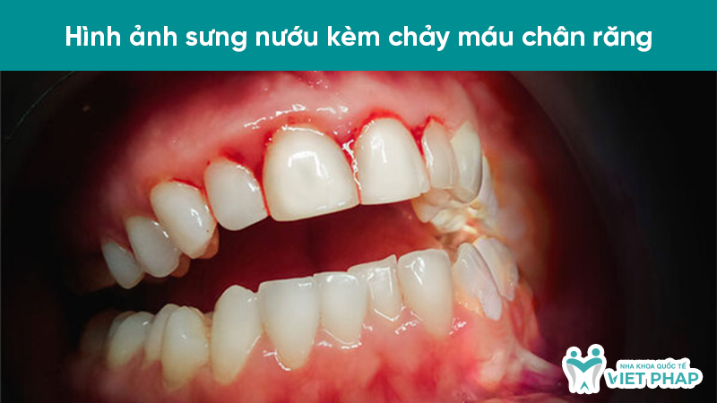 Hình ảnh sưng nướu kèm chảy máu chân răng