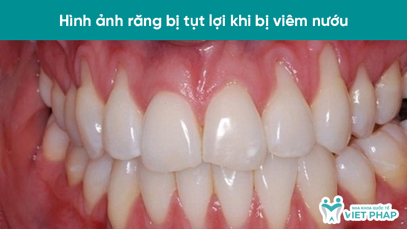 Hình ảnh răng bị tụt lợi khi bị viêm nướu