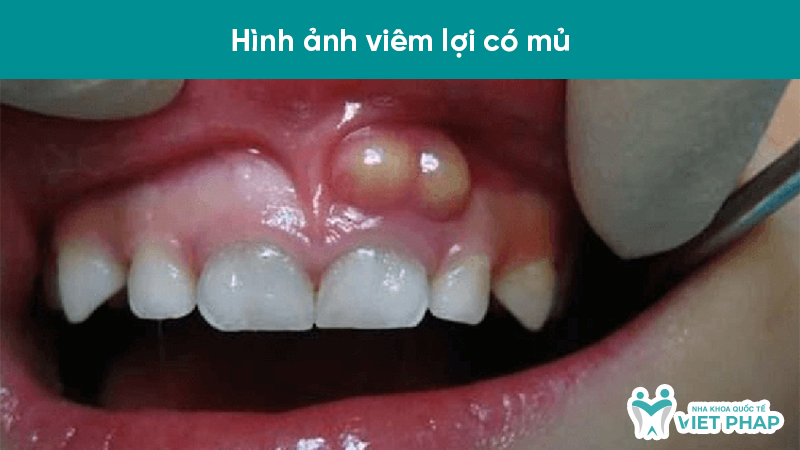 Hình ảnh viêm lợi có mủ