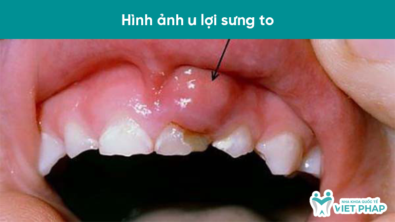 Hình ảnh u lợi sưng to
