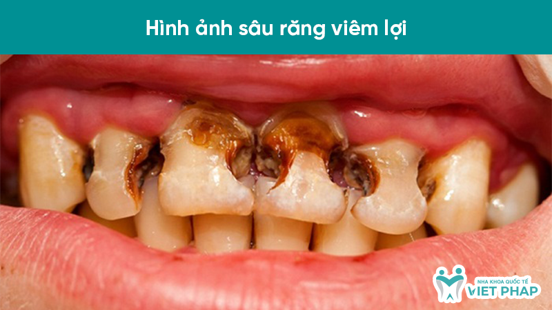 Hình ảnh sâu răng viêm lợi
