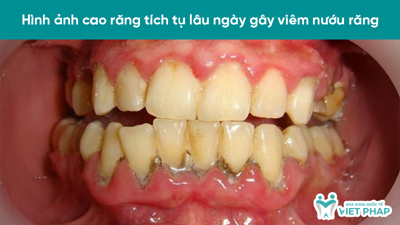 Hình ảnh cao răng tích tụ lâu ngày gây viêm nướu răng
