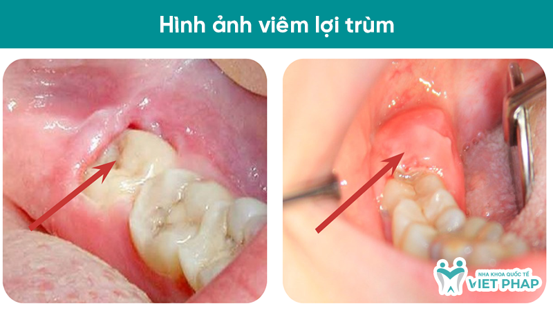 Hình ảnh viêm lợi trùm