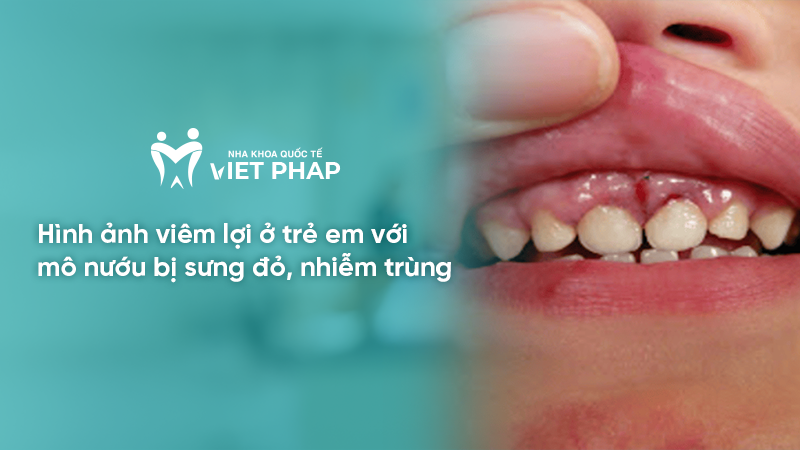 Hình ảnh viêm lợi ở trẻ em với mô nướu bị sưng đỏ, nhiễm trùng