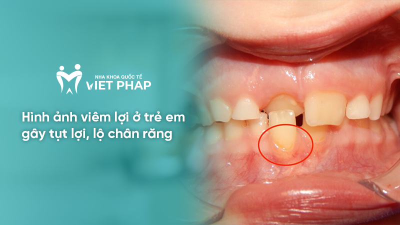 Hình ảnh viêm lợi ở trẻ em gây tụt lợi, lộ chân răng