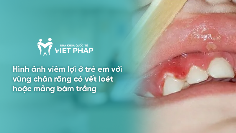 Hình ảnh viêm lợi ở trẻ em với vùng chân răng có vết loét hoặc mảng bám trắng